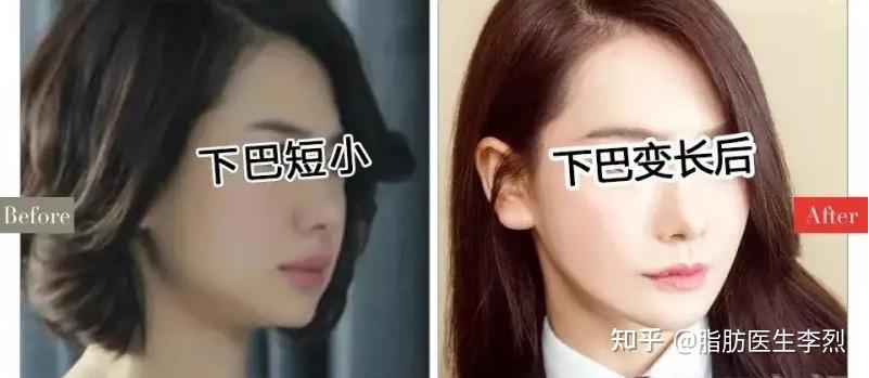 如何改善颏唇沟深的问题?(请看简介)? - 知乎