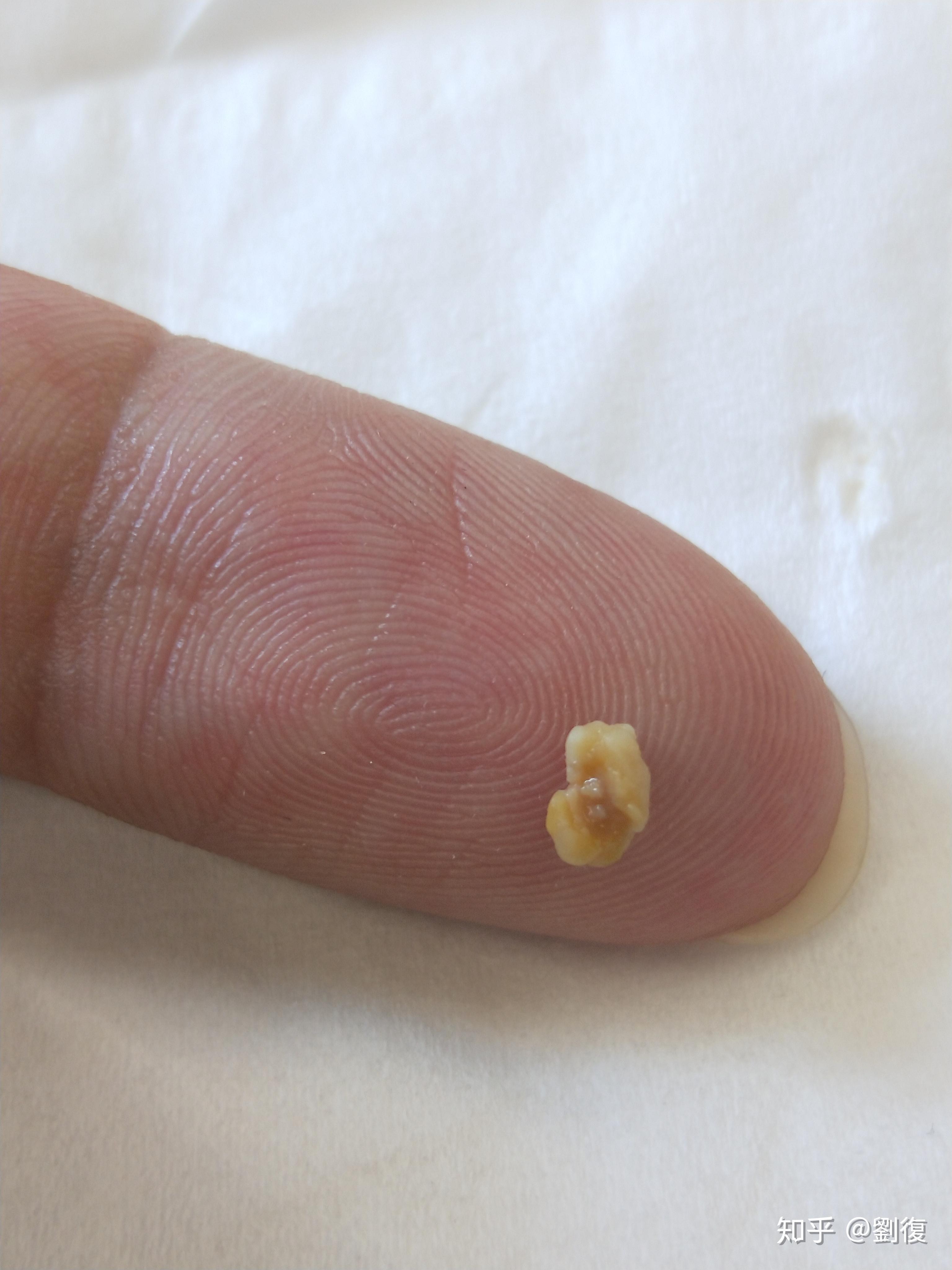 嘴巴里经常咳出吐出黄色颗粒很臭是什么