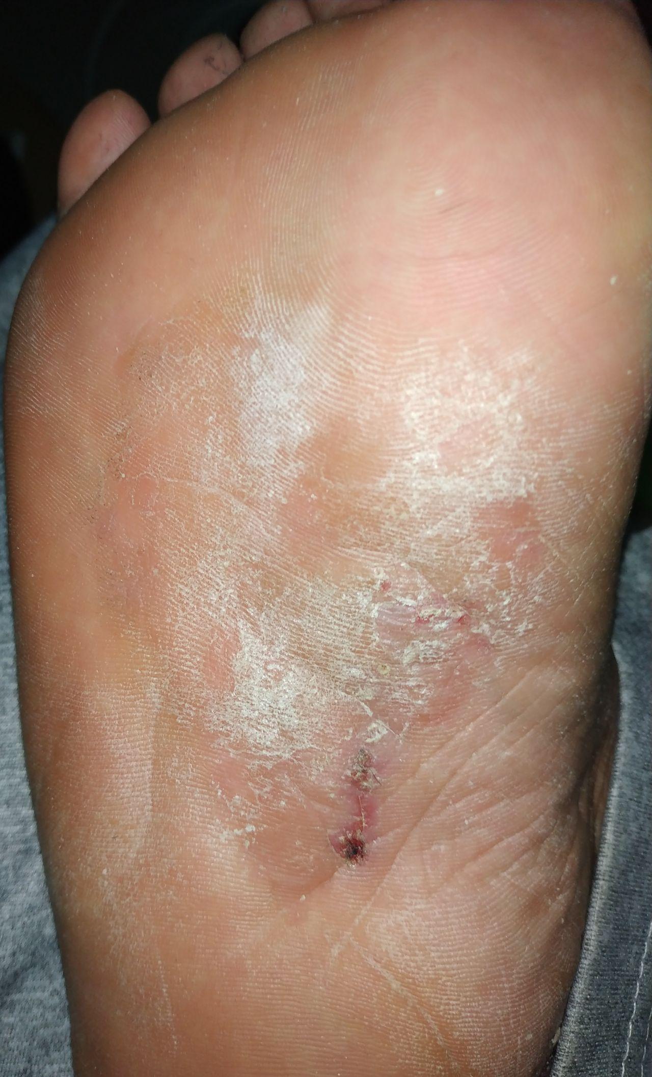 脚底起泡后皮肤有点溃烂.怎么办? - 知乎