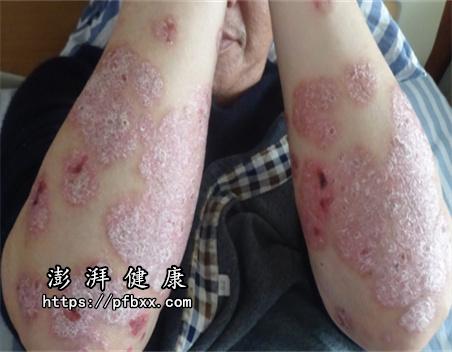 双手胳膊肘发红斑上面长厚厚苔癣是什么病症应该怎么治