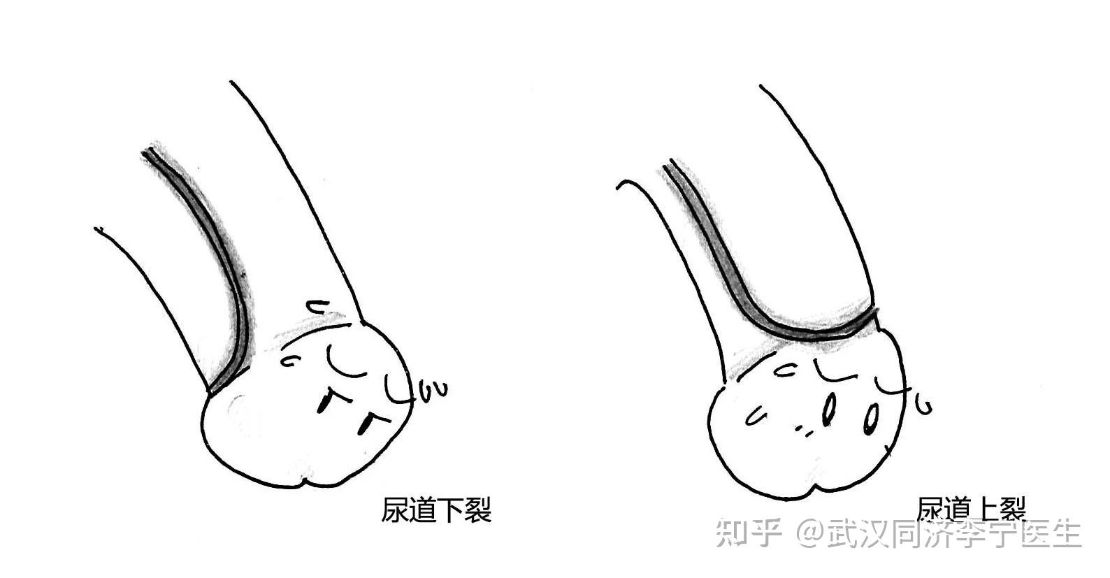 我国第四大出生缺陷疾病尿道下裂