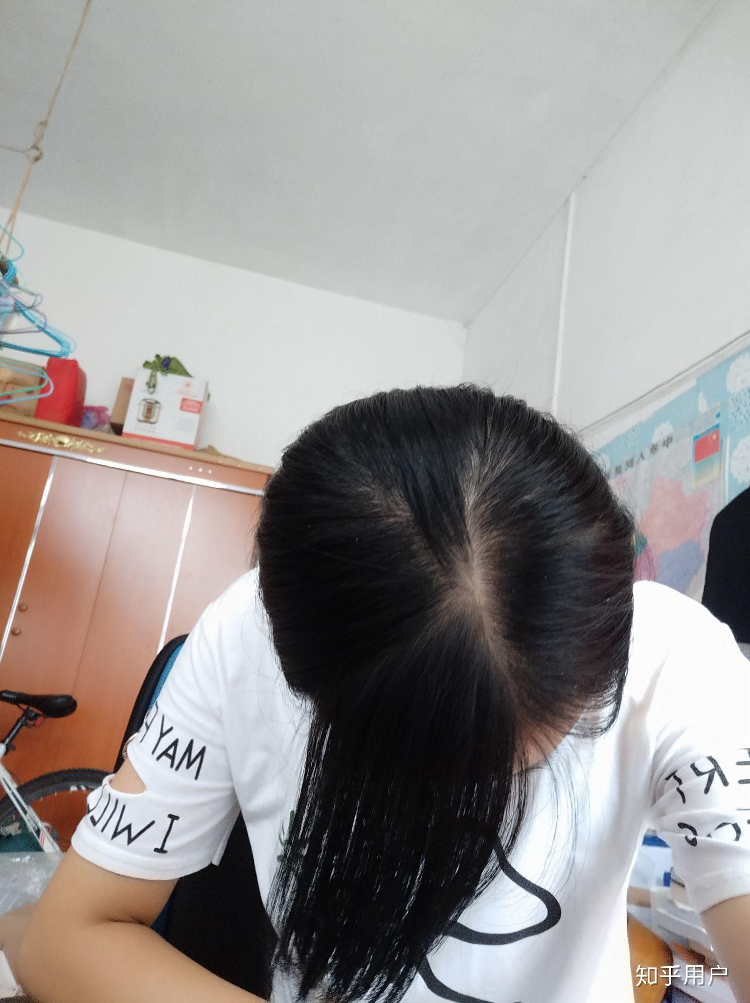 20岁女生脱发严重恐怖级别