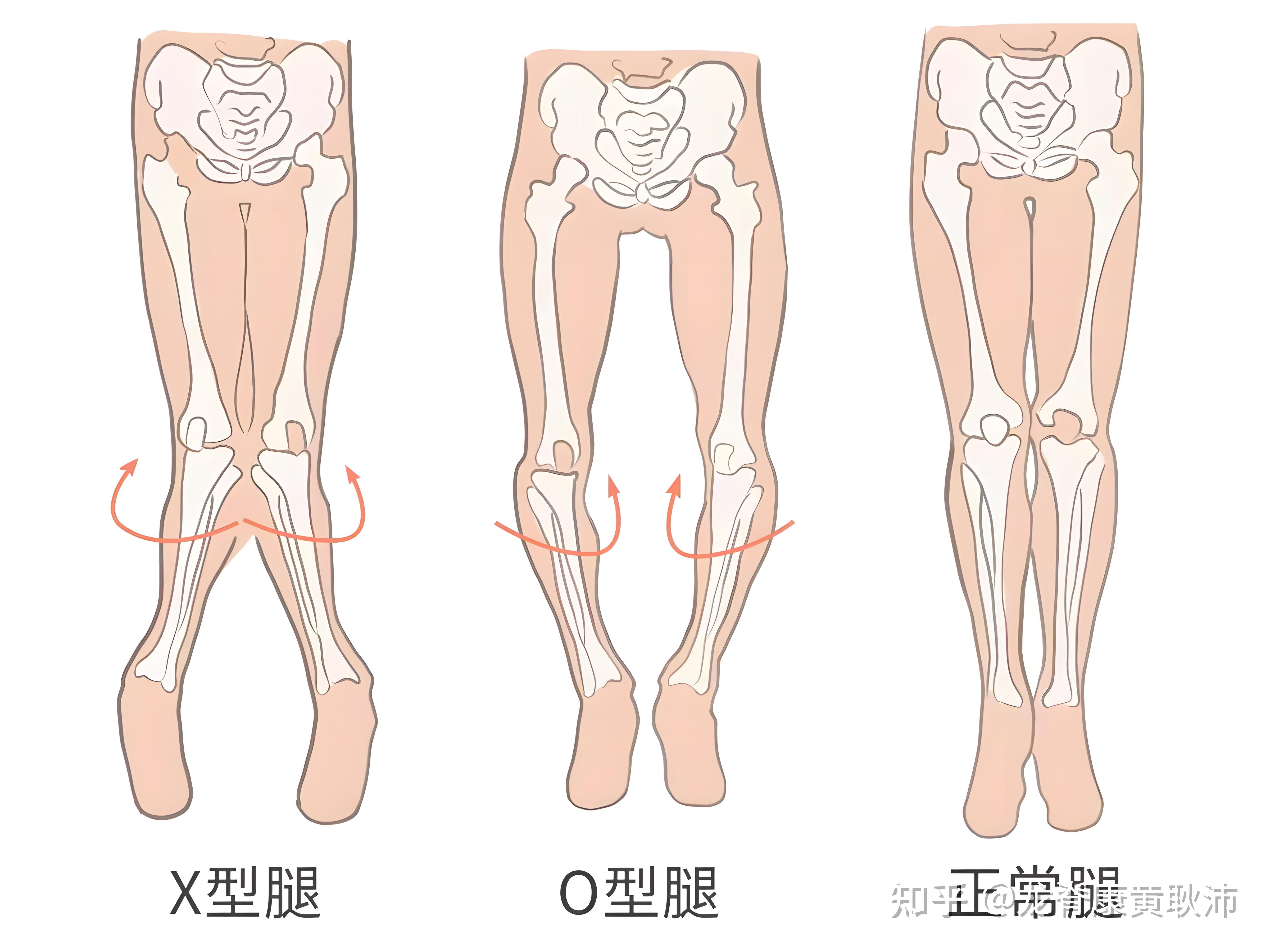 20岁xo型腿还可以矫正吗?