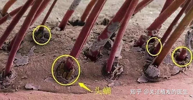 梳子上面,会滋生大量的螨虫,长期使用,可能还会导致交叉感染,使人脱发