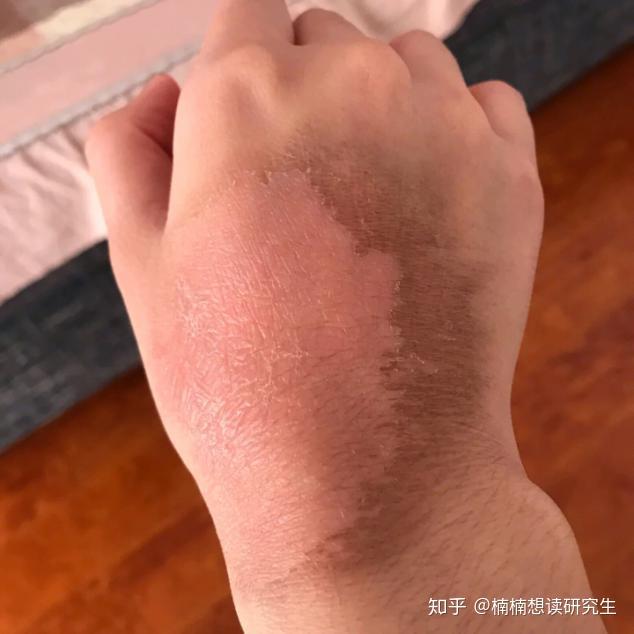 手背开水烫伤怎么恢复