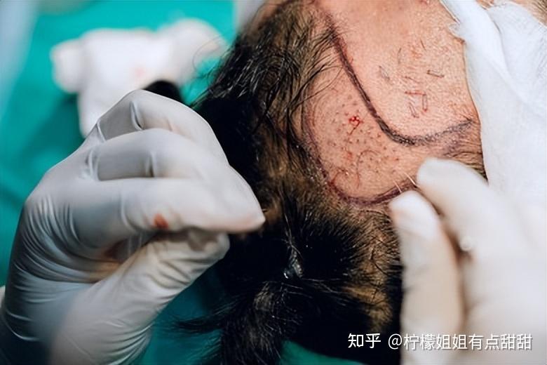 合肥植发是怎么植上去的(合肥植发有什么好处和坏处)