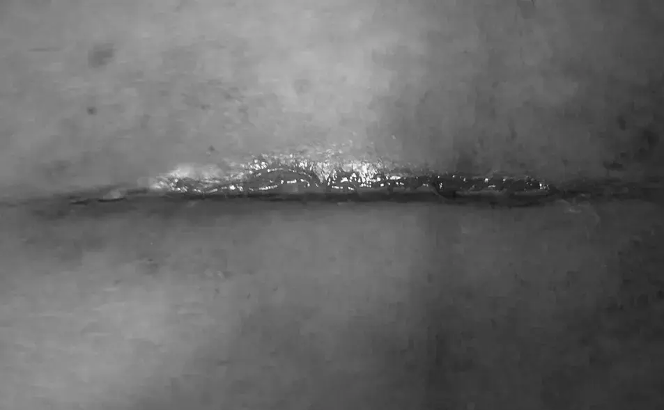 脂肪液化是手术伤口愈合不良的主要原因之一,特别是切口处脂肪较多的