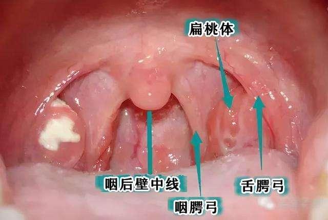 扁桃体坑坑洼洼的图片图片