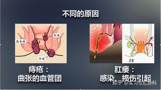 肛裂和肛瘘和痔疮怎么分辨