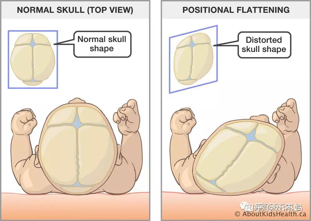 在孩子前4个月,活动能力还很差,头骨又非常柔软的时候,是头骨变形的