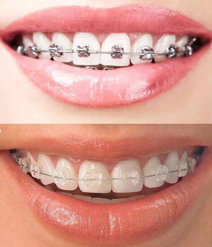 是最早的牙套类型,已经有丰富的临床经验. b.价格最便宜. · 缺点: a.