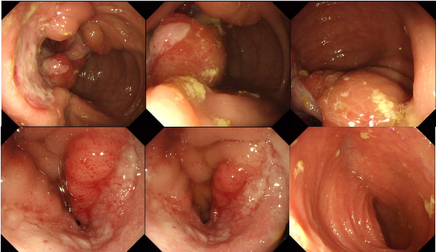 肠道溃疡除了炎症性肠病还可能是这种病很容易漏诊