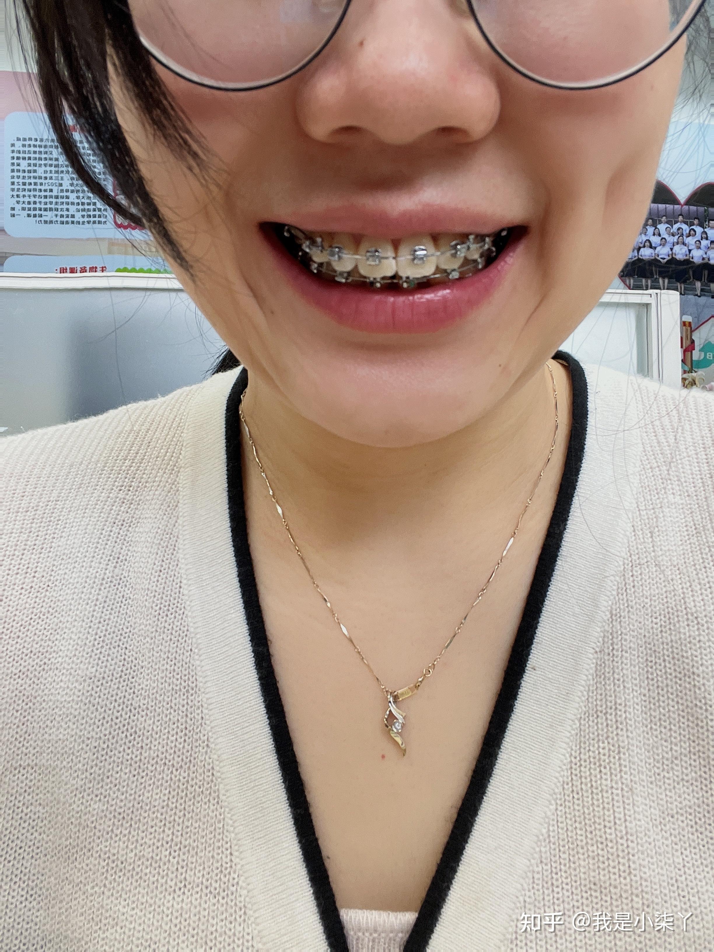 28岁小龅牙的整牙之旅
