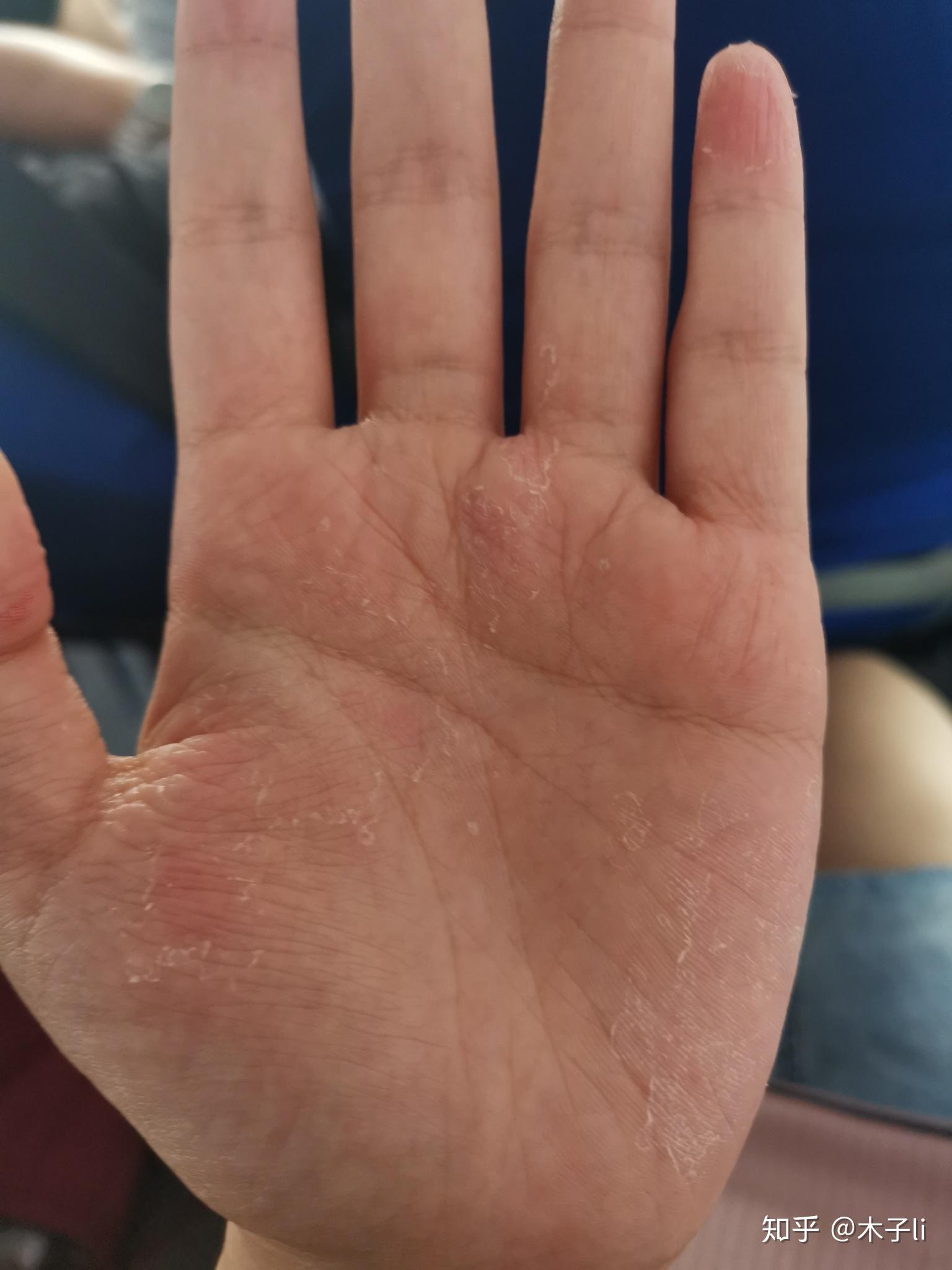 手部湿疹能根治吗? - 知乎