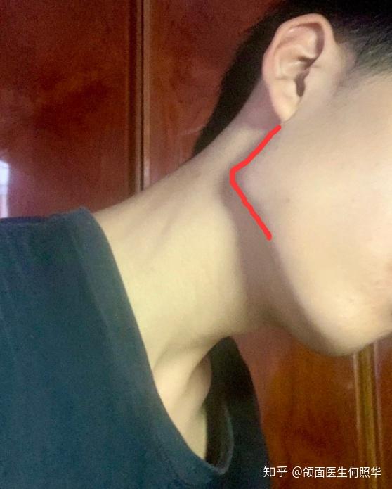 我这个下颌角是不是突出了?