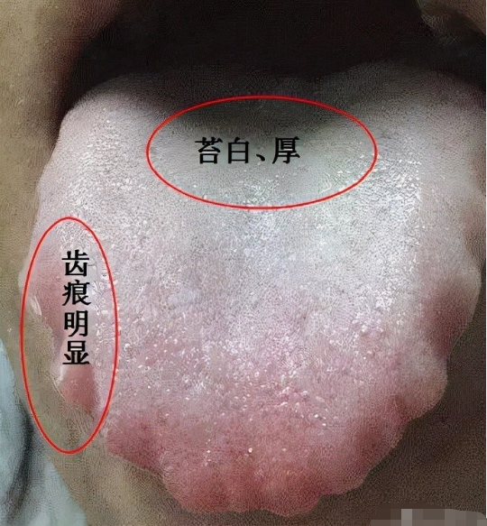 网友答疑:舌头两侧有齿痕是怎么回事? - 知乎