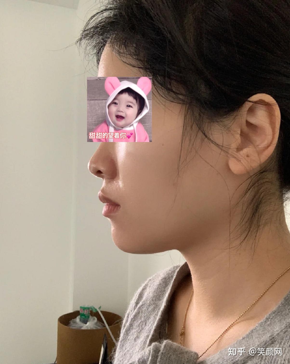 龅牙做完矫正后会有什么改变