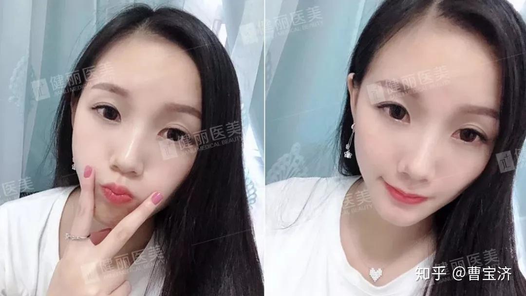 去眼袋前的她像頹廢老阿姨,去眼袋後妥妥的變身美少女了~這變化你羨慕