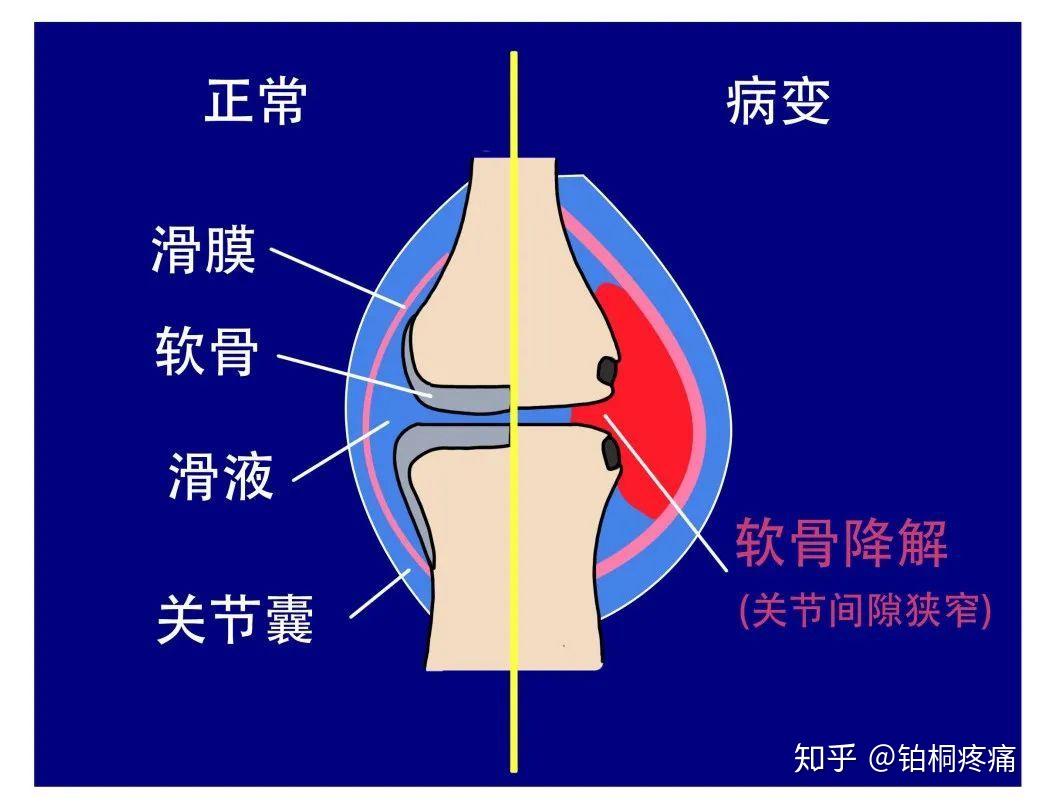 老年人要考慮到骨性關節炎及膝關節遊離體等疾病的可能性