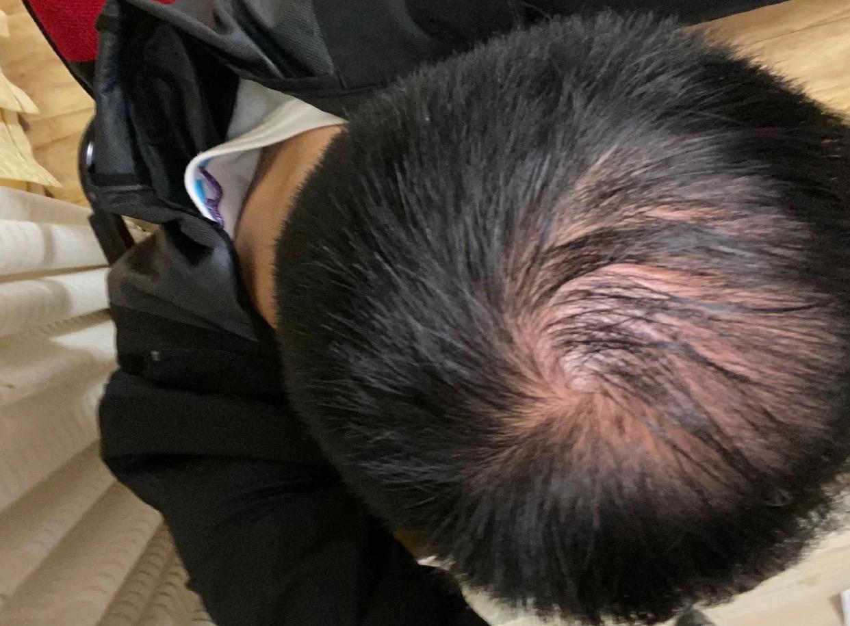 男朋友头发太少显丑怎么办?