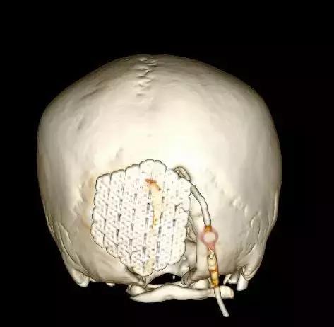 顱骨修補術後引發分流感染,腦積水復發及第四腦室嚴重擴大,在腦脊液科