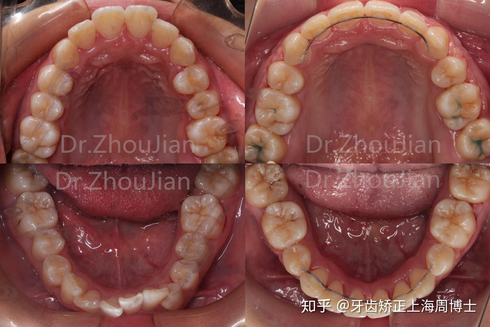 牙齿正畸需要拔掉4颗牙齿之后只剩下24颗牙齿这样正常吗