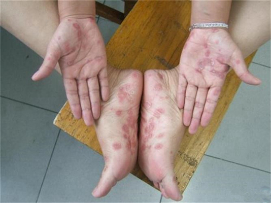 手足癣是真菌感染引起,它对于皮肤损害有一特点,即边界清楚,可逐渐向