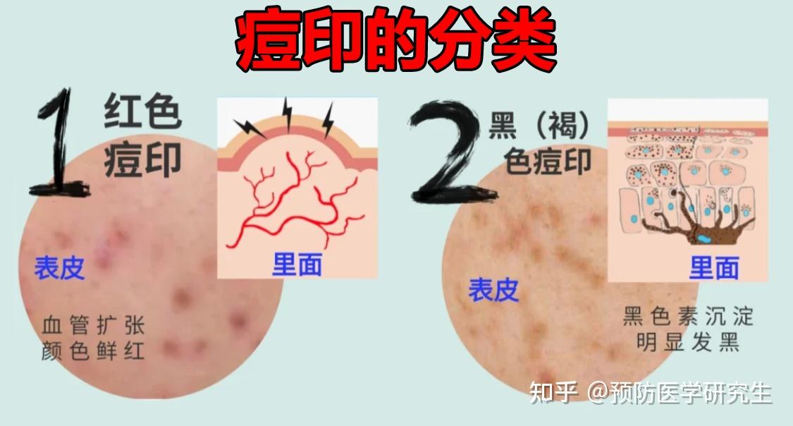 满脸都是脏兮兮的痘印,到底应该怎么办?专业配方师科普正确去痘印的方法!认准这4种成分,去除痘印,恢复俊秀容颜!