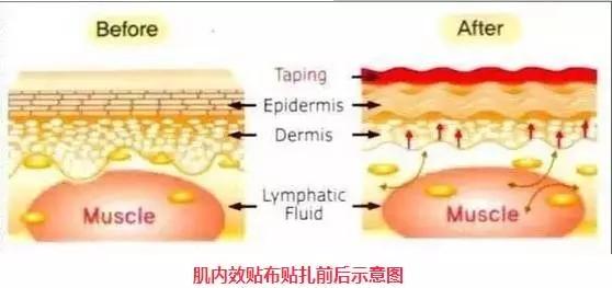 肌内效贴布是啥 科学化正视 知乎