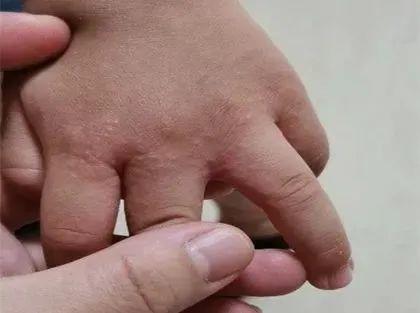 夏天来了,孩子手上密密麻麻又很痒的小疙瘩,是什么?怎么办?