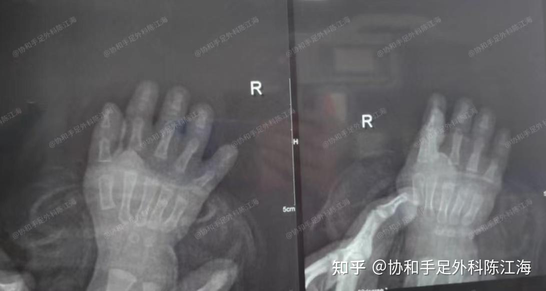 并指免植皮|案例17《孩子双手差异大,术后手大了,也灵活了》 - 知乎