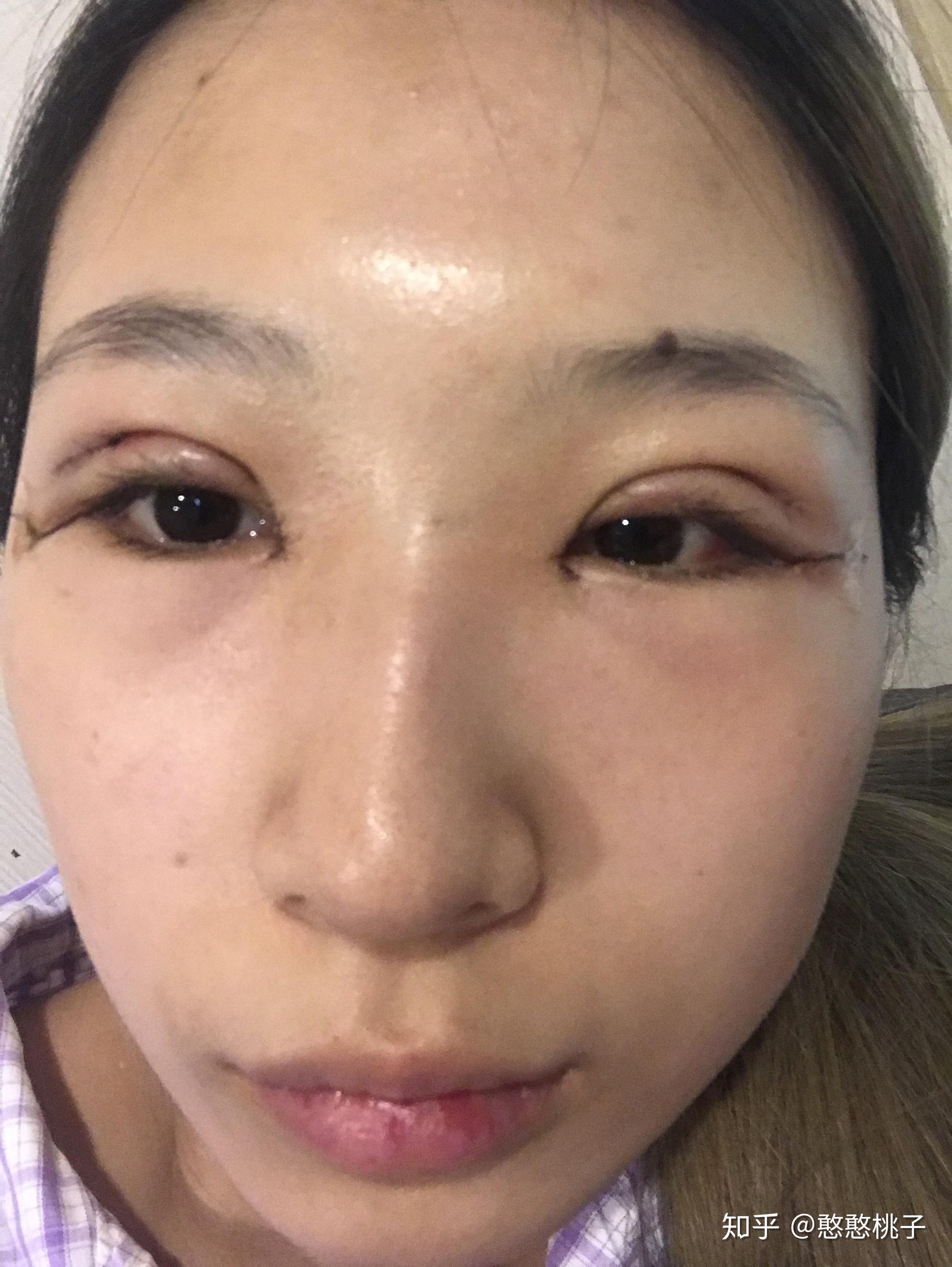 刚割完双眼皮是不是都特丑啊