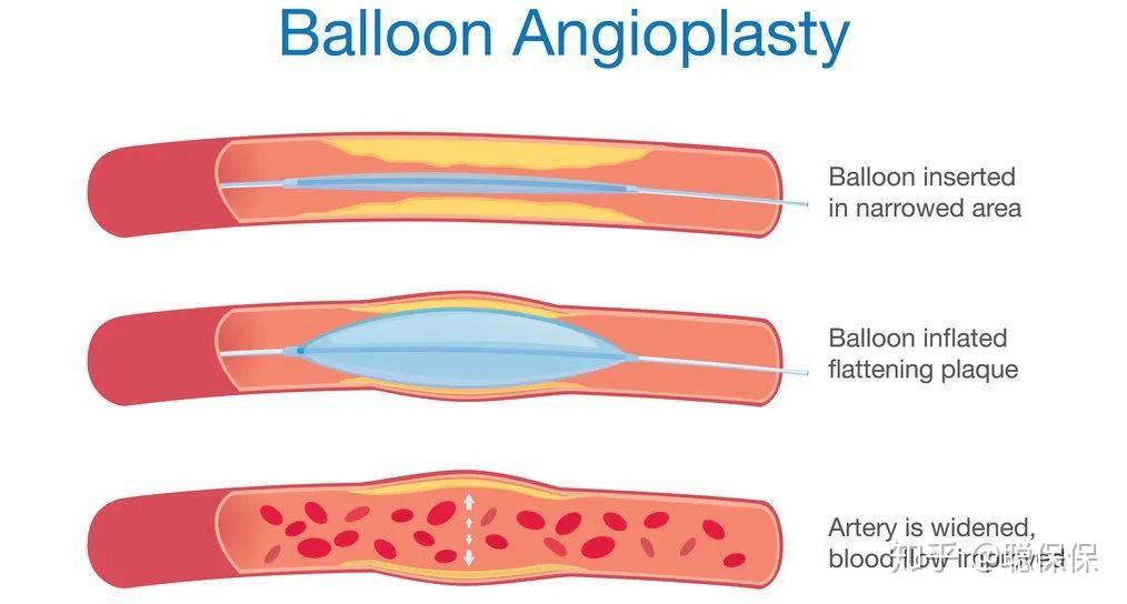 有钱真的可以任性!从心血管疾病治疗,看商业健康险的功用 - 知乎