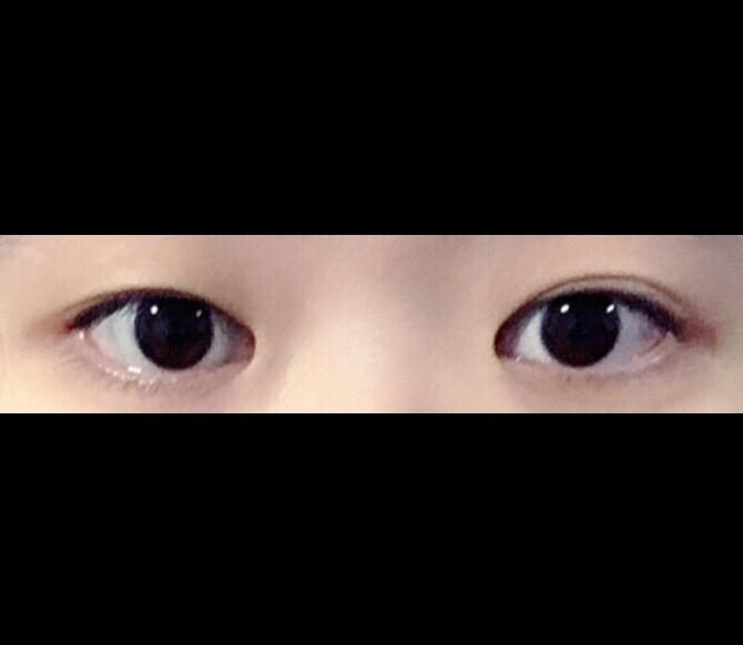 我女朋友一个眼睛内双一个眼睛外双显得一个大一个小所以很郁闷有大神