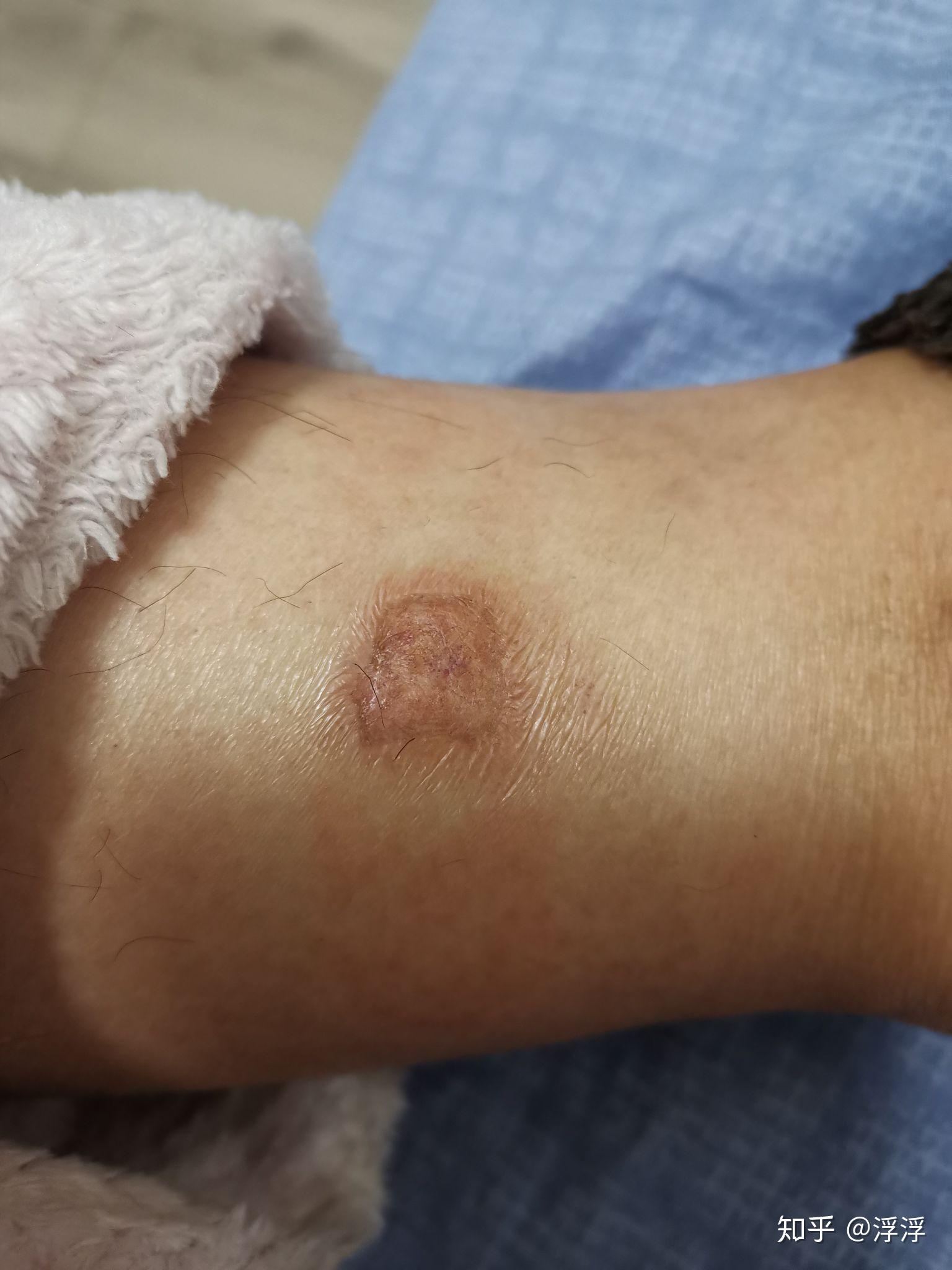 艾灸烫伤没有戳破,多长时间能恢复? - 知乎