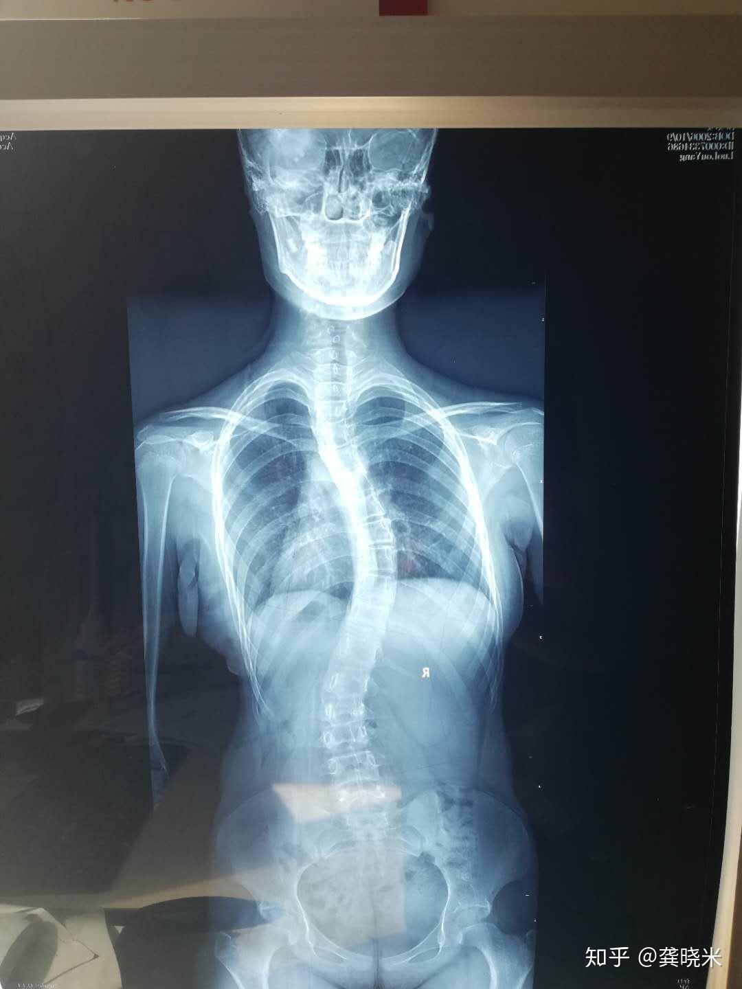 驼背和脊柱侧弯的区别在哪儿纠正方法有什么不一样吗