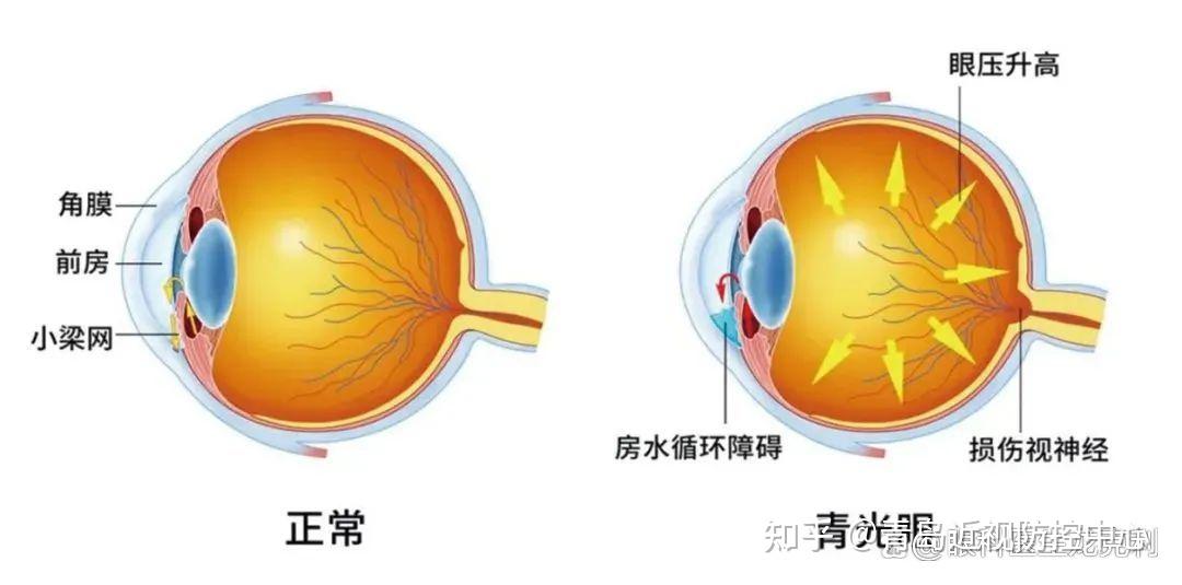 继发性青光眼拖延不得