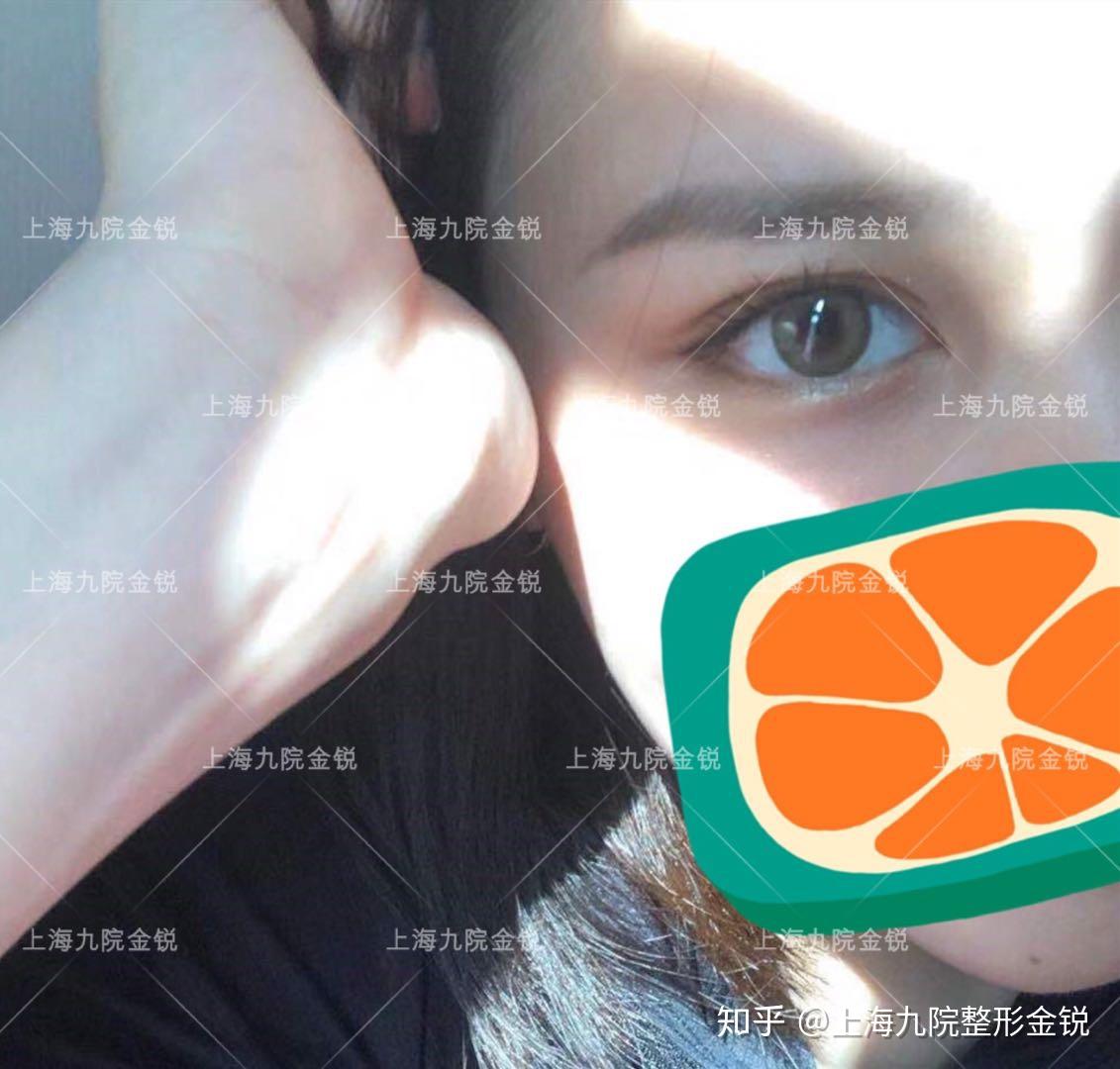上海九院金锐双眼皮案例