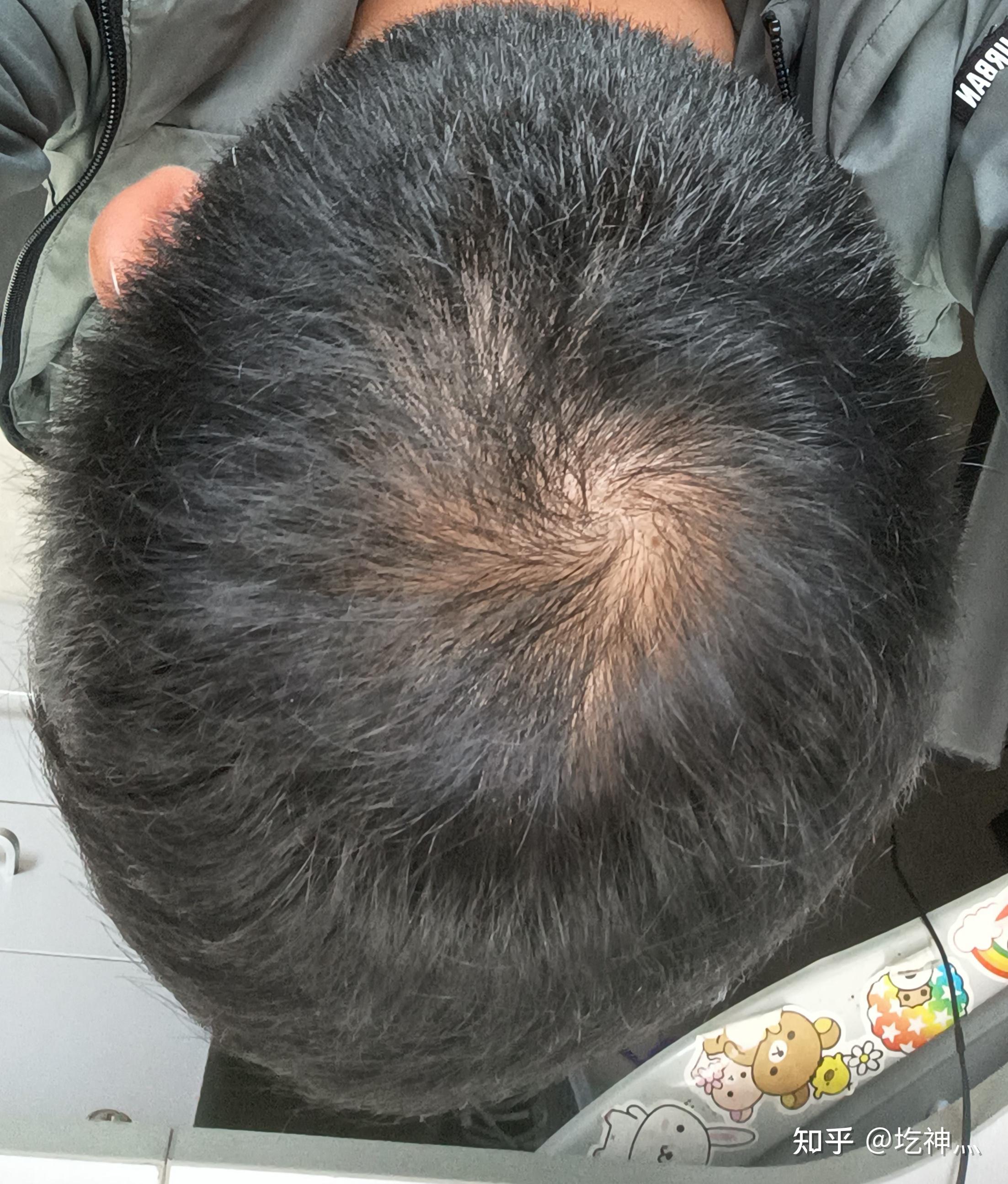 植发真的有那么神奇吗(植发究竟有没有用)