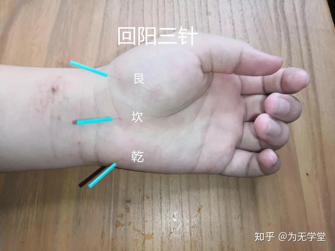 高血压如何用针灸缓解?