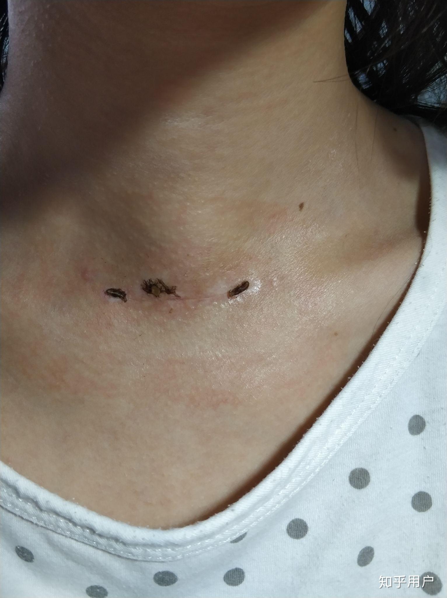做过甲状腺结节切除手术后一年还未满一年怎样抚平脖颈上的疤痕疤痕约