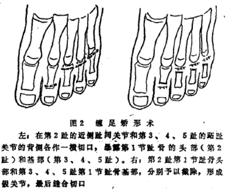 宋明时侧缠足的方法是否需要折断脚骨呢还有侧缠是何时变成折骨缠的呢