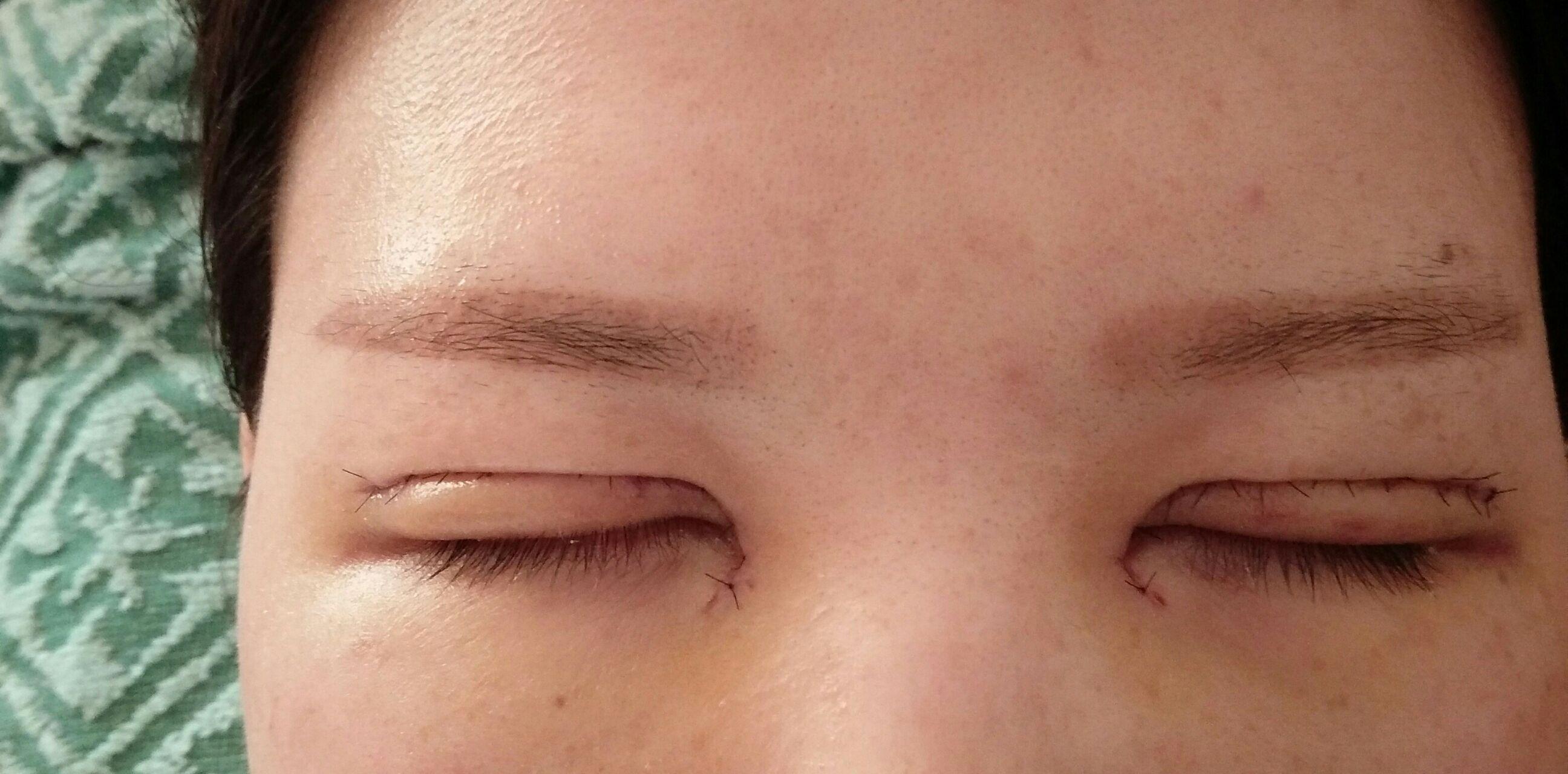 全切双眼皮20多天了这是肉条还是肿眼皮很松弛闭眼后切口上的眼皮会