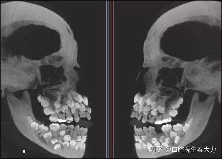 关于多齿症是真的吗？ - 知乎