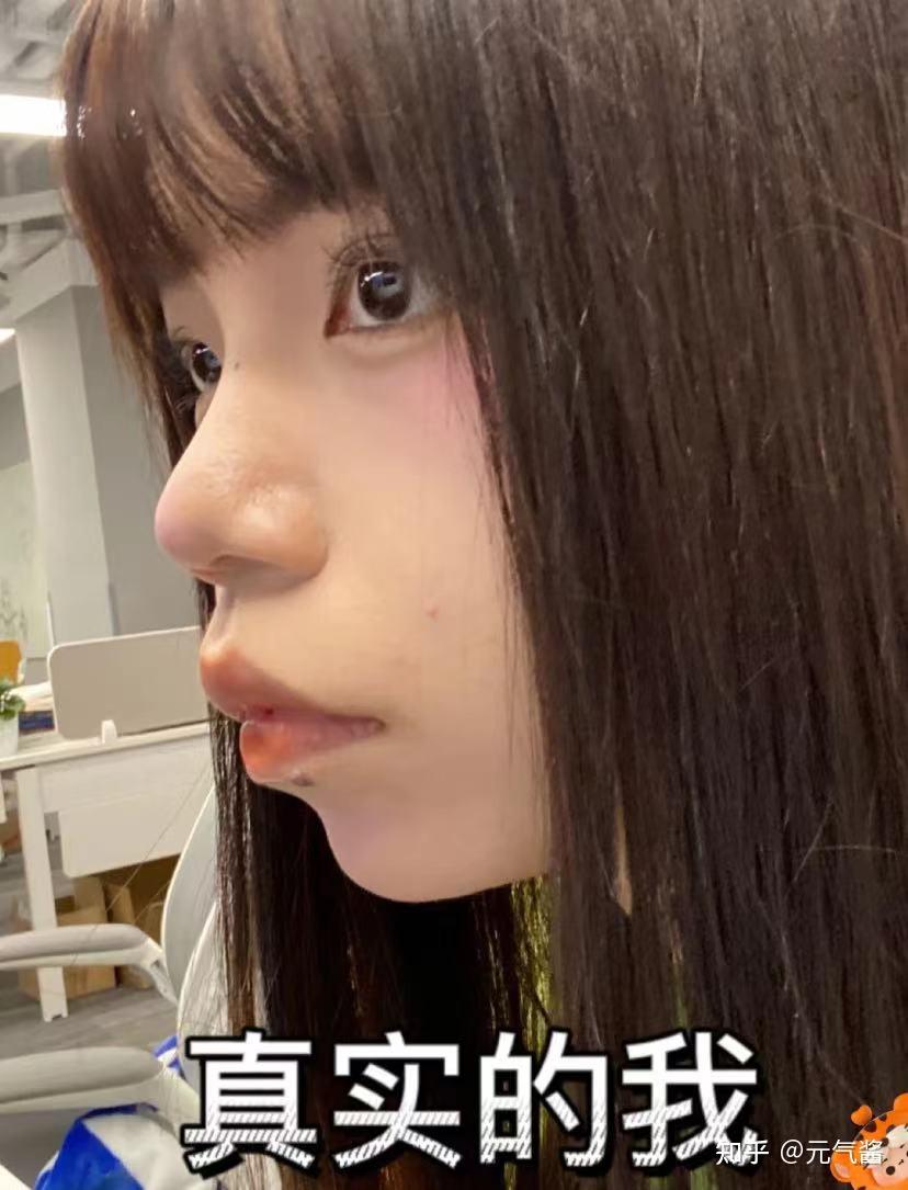 北大口腔李阳正颌骨性凸嘴手术上岸马不停蹄来分享感受