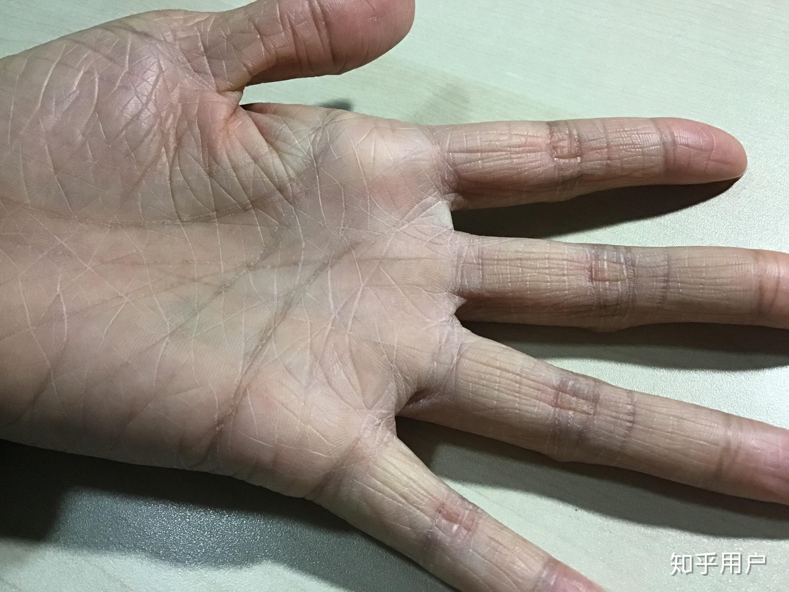 请问鱼鳞病患者的手都是老人手吗