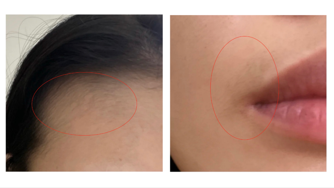 米诺地尔千万别乱用,小心满脸长毛!