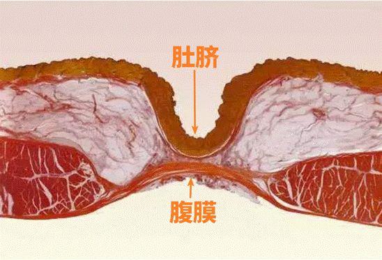 脐正中韧带图片