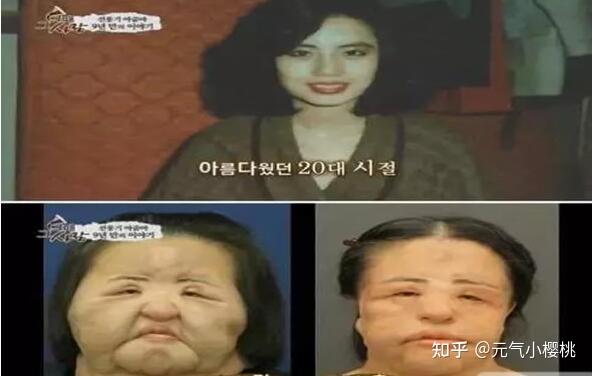 六例全球整容案例巴西狗头人的奇葩改造手术