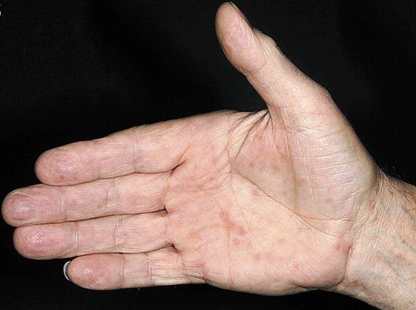 从感染梅毒到18很严重吗了解梅毒的危害和影响